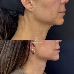cuello 1
