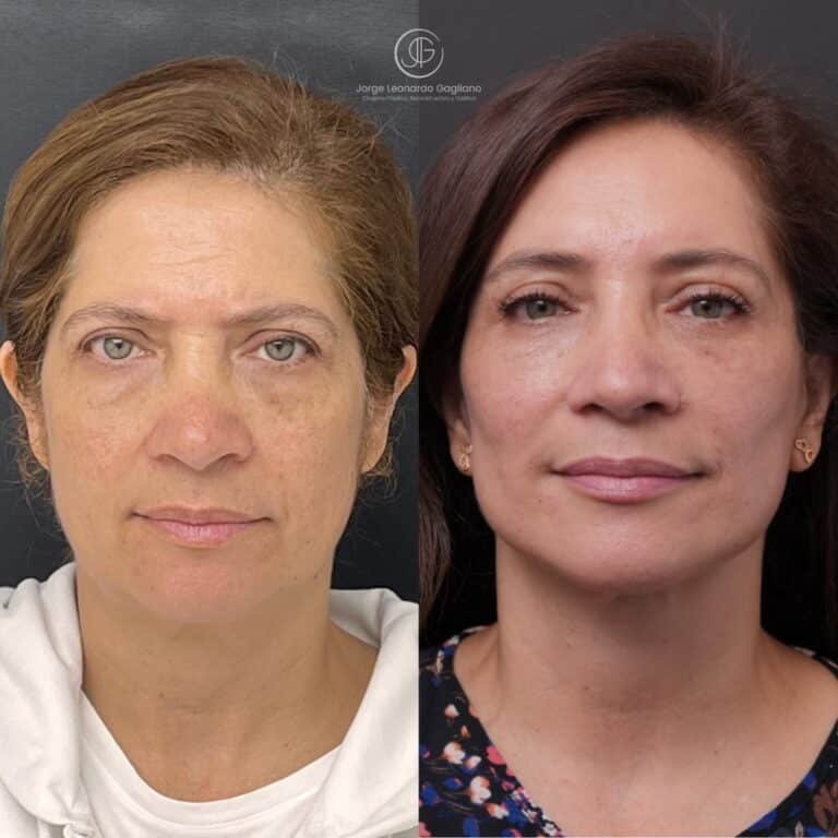 rejuvenecimiento facial